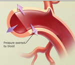 polycystic kidney disease adpkd arpkd blood pressure hypertension