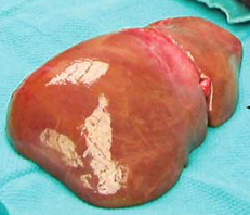 pld polycystic liver disease transplant
