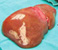 normal liver vs polycystic liver disease