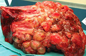 pld polycystic liver disease transplant