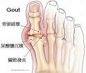 gout big toe pain PKD
