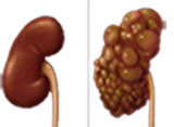 very low protein delays dialysis in elderly brunori, pkd polycystic kidney disease anemia LVH Left Ventricular Hypertrophy