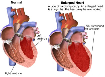 Do steroids increase the size of your heart