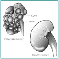 pkdiet.com alkalinediet.com polycysticliverdisease.com low protein diet, polycystic liver disease, polycystic kidney disease, pkd, adpkd, alpld, arpkd