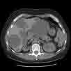 PLD adpld polycystic liver disease
