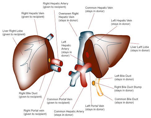 liver transplant PLD adpld polycystic liver disease liver transplant