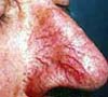 telangectasias PLD polycystic liver disease xenoestrogens